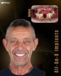 Результат до та після імплантації All-on-6 у SmileBox Dental Clinic - Thonglor
