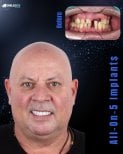 Результат до та після імплантації All-on-5 у SmileBox Dental Clinic - філія Тонглор