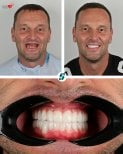 Résultat avant/après implants dentaires All-on-4 chez Soraca Med – sourire restauré