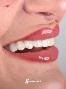 Résultat implants dentaires All-on-4 chez Soraca Med – sourire restauré naturel