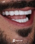 Résultat implants dentaires All-on-4 chez Soraca Med, sourire restauré naturel