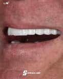 Résultat implants dentaires All-on-4 chez Soraca Med – dents supérieures restaurées naturellement