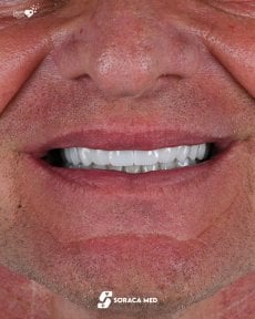 Résultat des implants dentaires All-on-4 chez Soraca Med – sourire restauré naturel