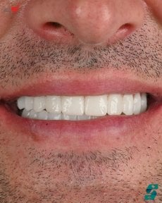 before-after photo dental-implant