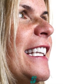 before-after photo dental-implant