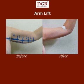 before-after photo korrekcia-figury-mommy-makeover