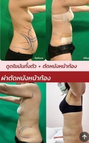 before-after photo korrekcia-figury-mommy-makeover