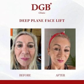 before-after photo korrekcia-figury-mommy-makeover