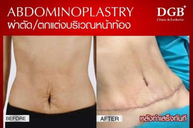 before-after photo korrekcia-figury-mommy-makeover