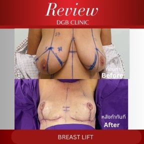 before-after photo korrekcia-figury-mommy-makeover