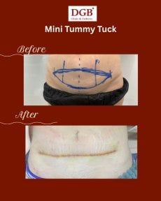 before-after photo korrekcia-figury-mommy-makeover