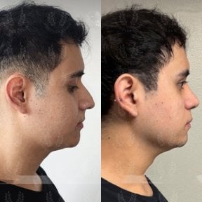 Before and after facial fat transfer results at Dr. Safa Manav Clinic, improved jawline contour