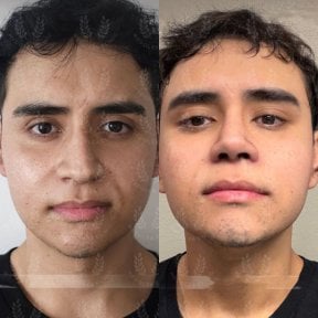 Facial fat transfer before and after results at Dr. Safa Manav Clinic, enhanced facial volume
