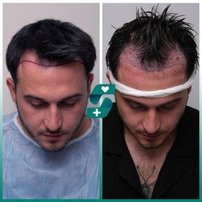 before-after photo hair-transplant