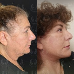 before-after photo tightening-of-facial-skin-facelift