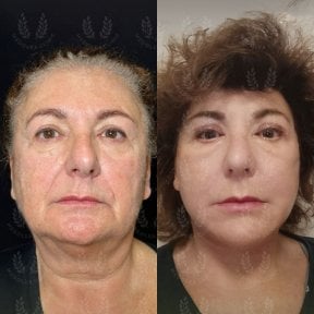 before-after photo deep-plane-facelift