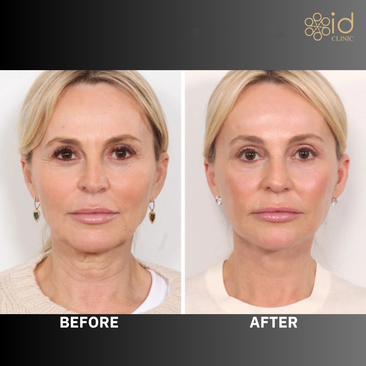 Resultados de blefaroplastia de párpado inferior antes y después en ID Clinic Bangkok