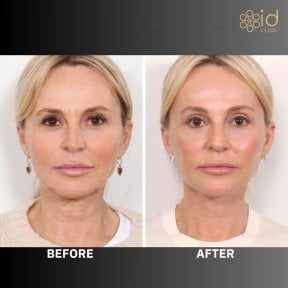 before-after photo lower-eyelid-surgery