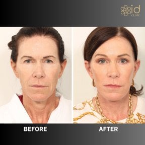 before-after photo lower-eyelid-surgery