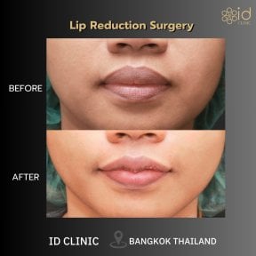 before-after photo rhinoplasty-nose-job