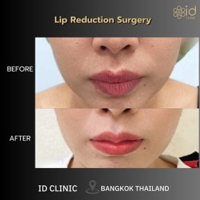 before-after photo rhinoplasty-nose-job