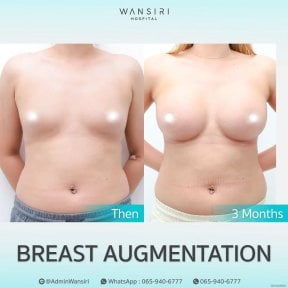 Before and after breast augmentation results at Wansiri Hospital, visible volume increase