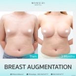 Before and after breast augmentation results at Wansiri Hospital, visible volume increase