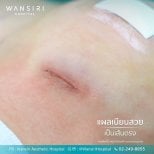 Male breast augmentation result at Wansiri Hospital – minimal scar after surgery