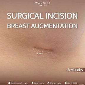 Male breast augmentation scar result at Wansiri Hospital, 2.5 cm incision after 6 months
