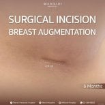 Male breast augmentation scar result at Wansiri Hospital, 2.5 cm incision after 6 months