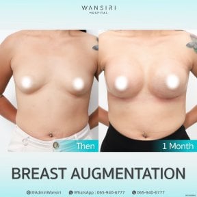 Before and after breast augmentation results at Wansiri Hospital, visible size enhancement