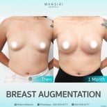 Before and after breast augmentation results at Wansiri Hospital, visible size enhancement
