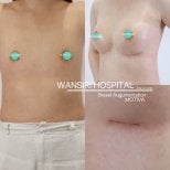 Before and after male breast augmentation results at Wansiri Hospital, visible chest enhancement