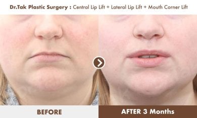 Before and after lip lift results at Dr. Tak Plastic Surgery, enhanced lip contour after 3 months