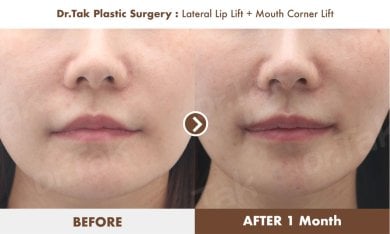 Before and after lip lift and mouth corner lift results at Dr. Tak Plastic Surgery clinic