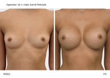 Before and after breast augmentation results at Klinika Promedion, enhanced breast volume