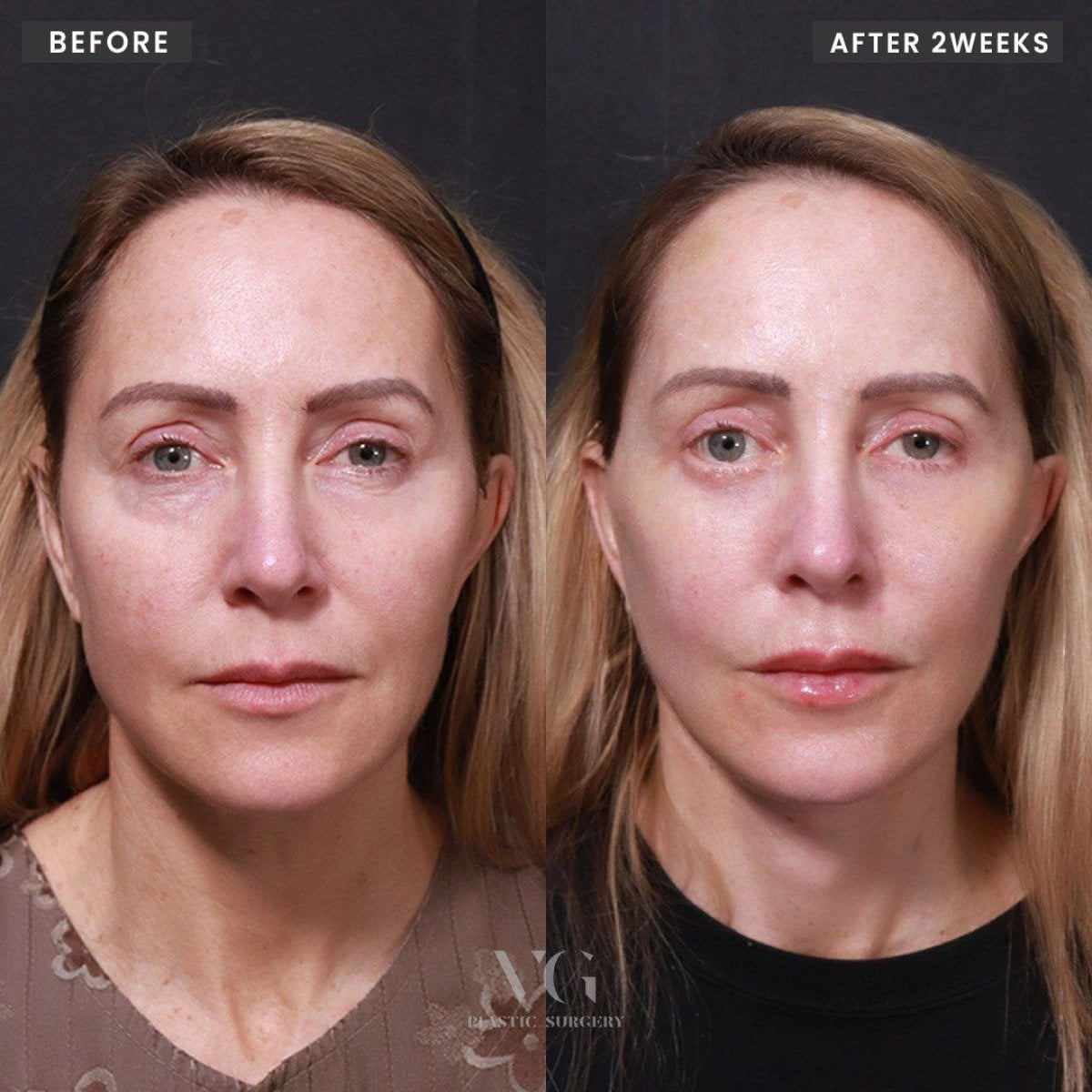 Resultados antes y después de deep plane facelift en VG Plastic Surgery, rejuvenecimiento facial
