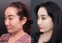 Before and after facelift results at VG Plastic Surgery – visible facial rejuvenation effect