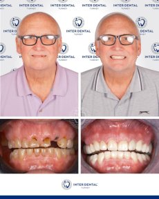 before-after photo dental-implant