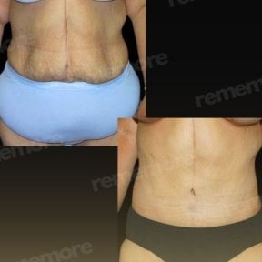before-after photo abdominoplastika-fleur-de-lis