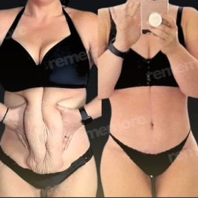 before-after photo abdominoplastika-fleur-de-lis