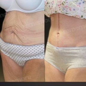 before-after photo abdominoplastika-fleur-de-lis
