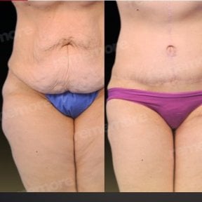 before-after photo abdominoplastika-fleur-de-lis