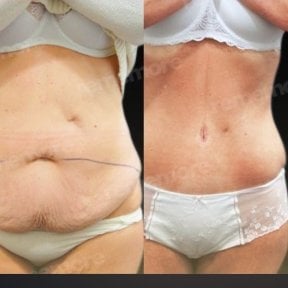 before-after photo abdominoplastika-fleur-de-lis