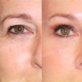 before-after photo upper-and-lower-eyelid-surgery