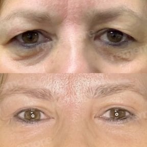before-after photo upper-and-lower-eyelid-surgery
