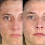 Before and after PRP therapy results for facial skin rejuvenation at Memorial Bahçelievler Hospital