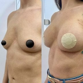 before-after photo mastopeksia-podtazka-grudi-konturnaa-plastika