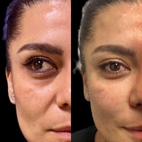 before-after photo inekcii-botoksa