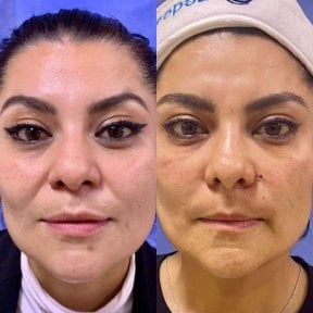before-after photo inekcii-botoksa